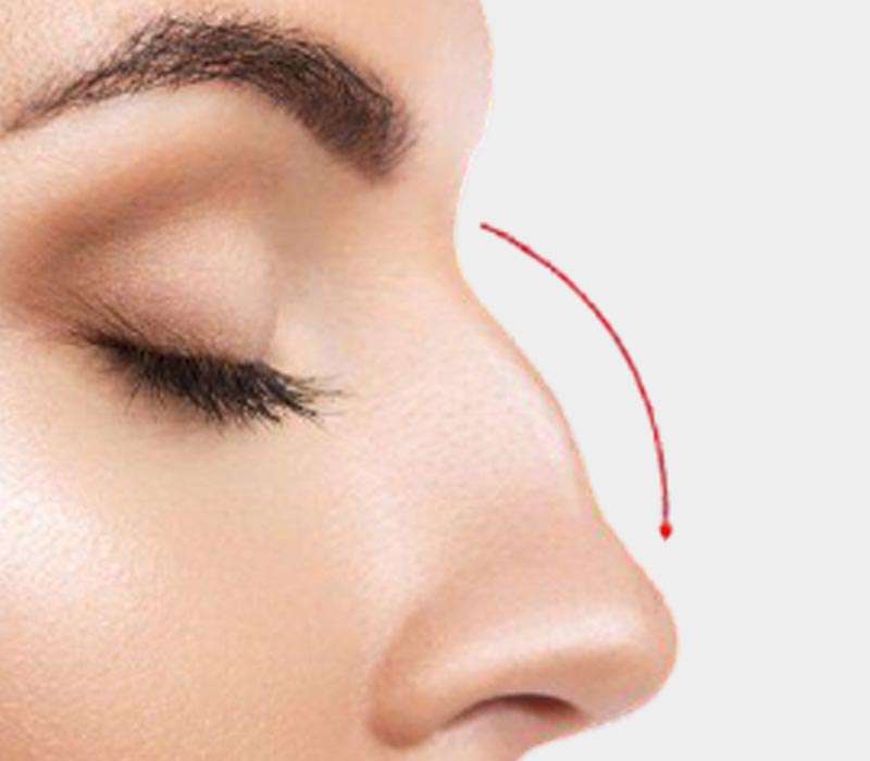 Nose Reshaping Surgery