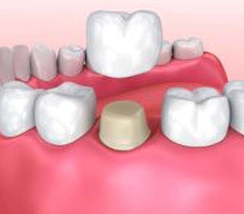 Dental Bridge