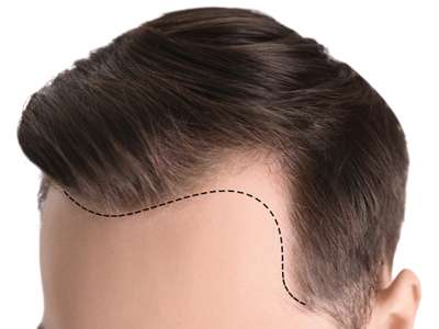 Hair Fall Treatment Clinic