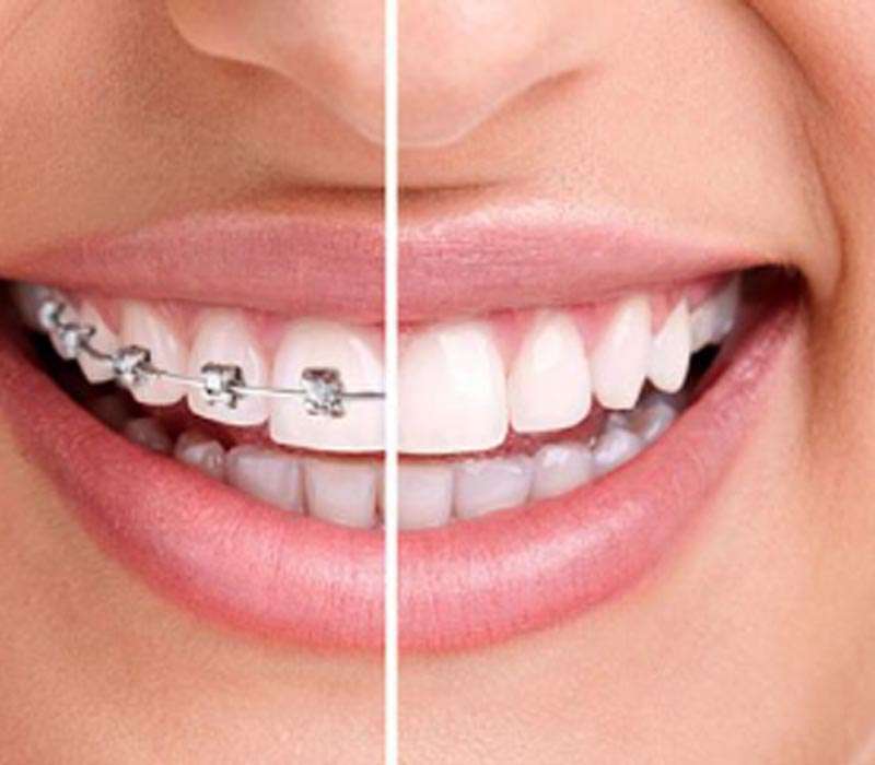 Orthodontics Treatment