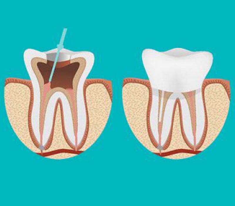 Root Canal Treatment