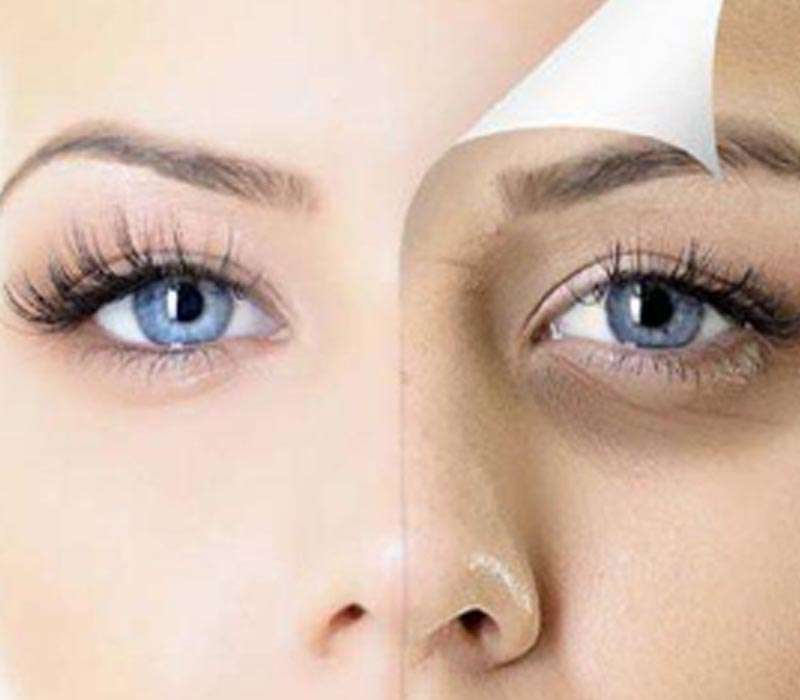 Under Eye Dark Circles Treatment